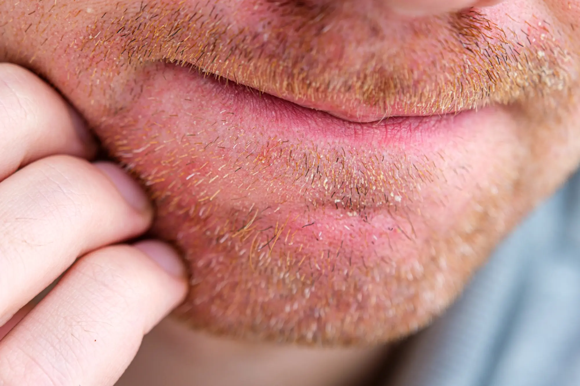 an example of Seborrheic Dermatitis